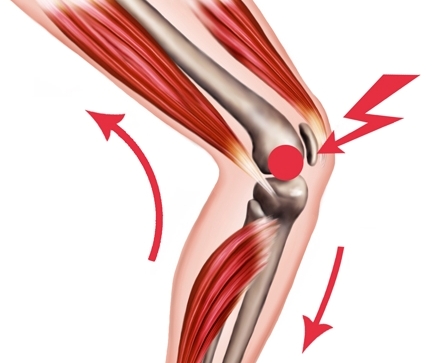 Probleme an der Patellasehne gut behandelbar