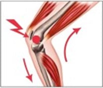 Knieproblem mit der Patellasehne