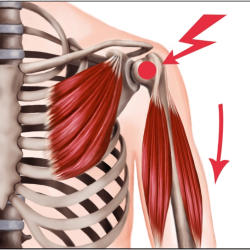 Schulterschmerzen und die Ursachen